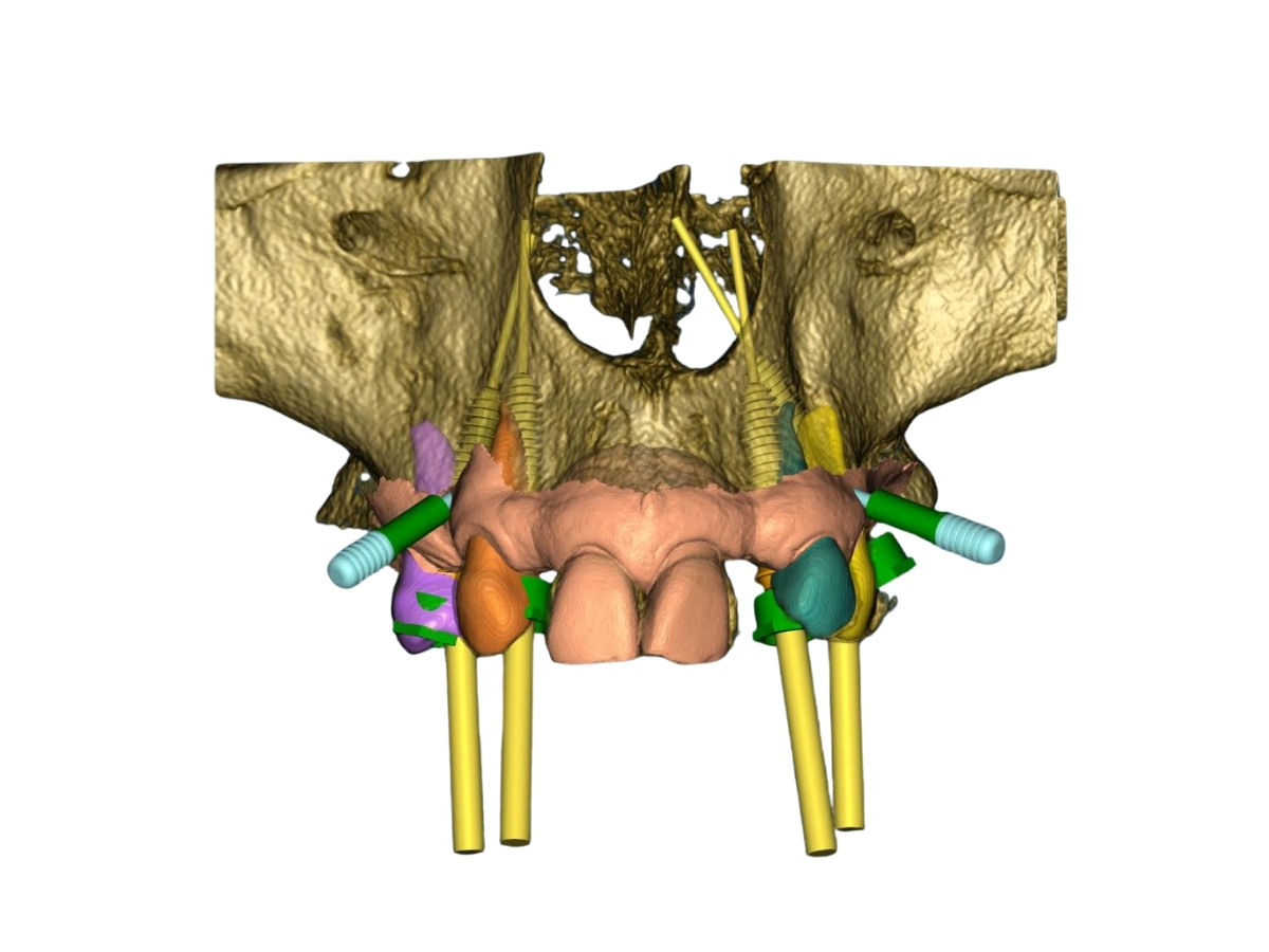 Ricostruzione 3D da TAC Cone Beam con pianificazione implantare