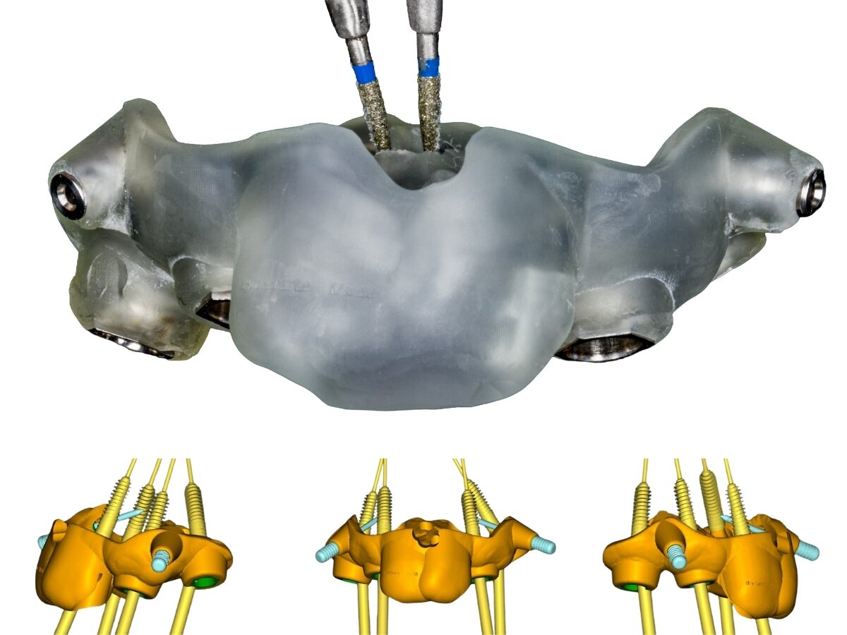 Dima chirurgica stampata in 3D per chirurgia implantare guidata