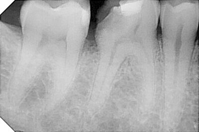 Radiografia prima della devitalizzazione