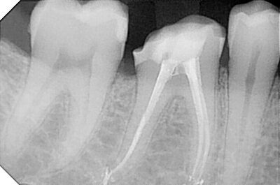 Radiografia durante la devitalizzazione