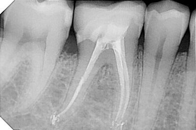 Radiografia dopo la devitalizzazione