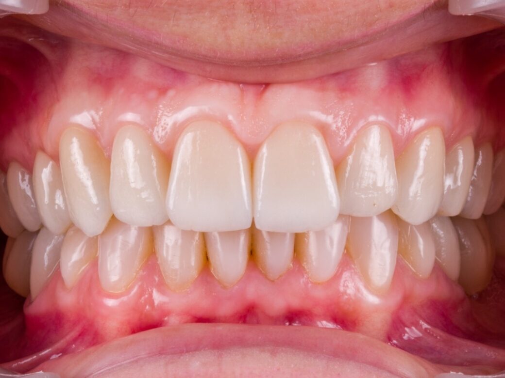 Estetica dentale — dopo