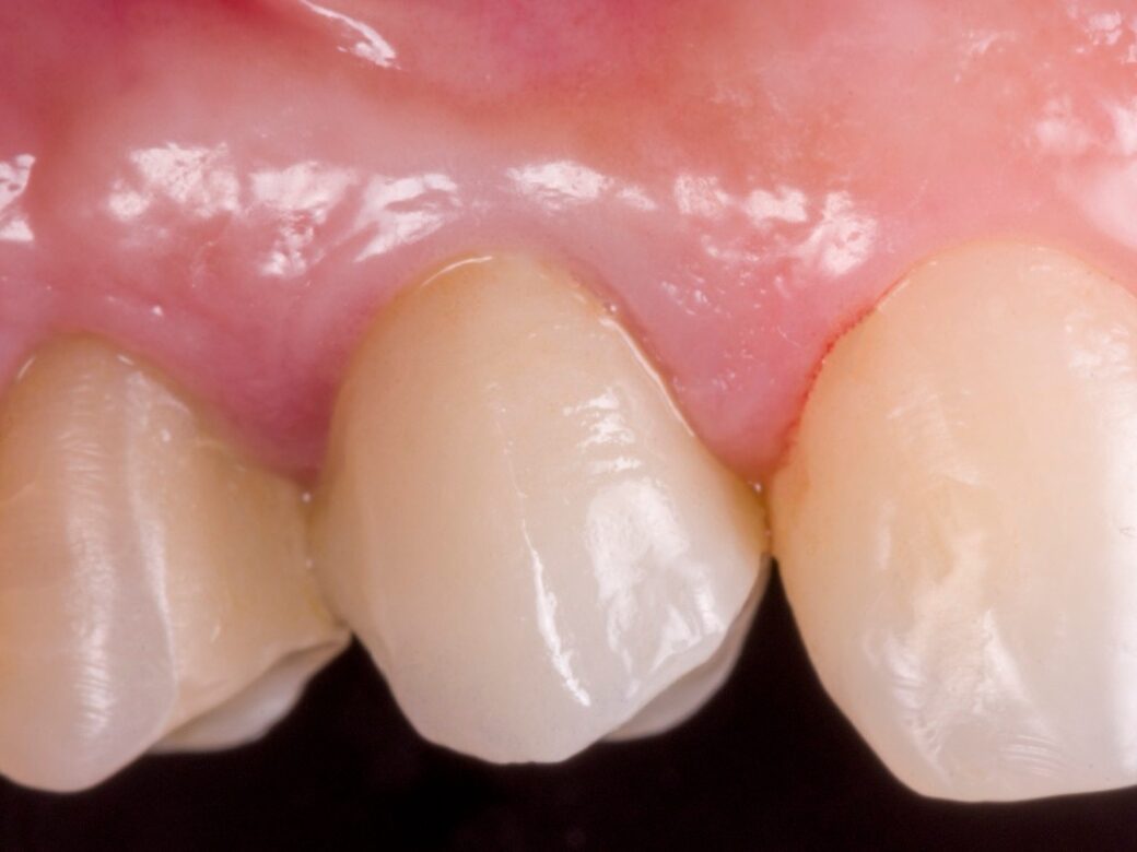 Estetica dentale — dopo