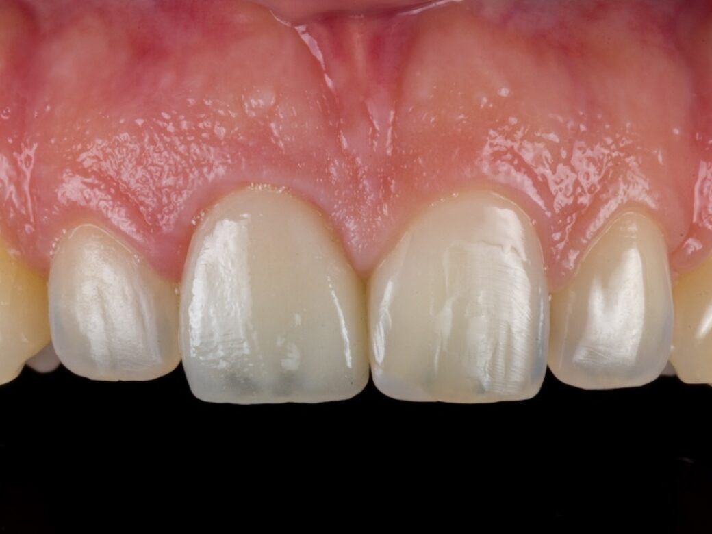 Estetica dentale — dopo
