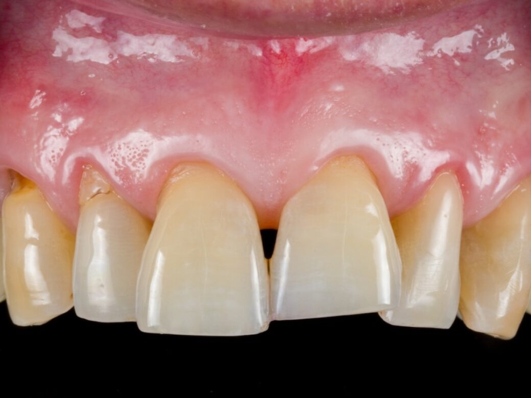 Estetica dentale — prima