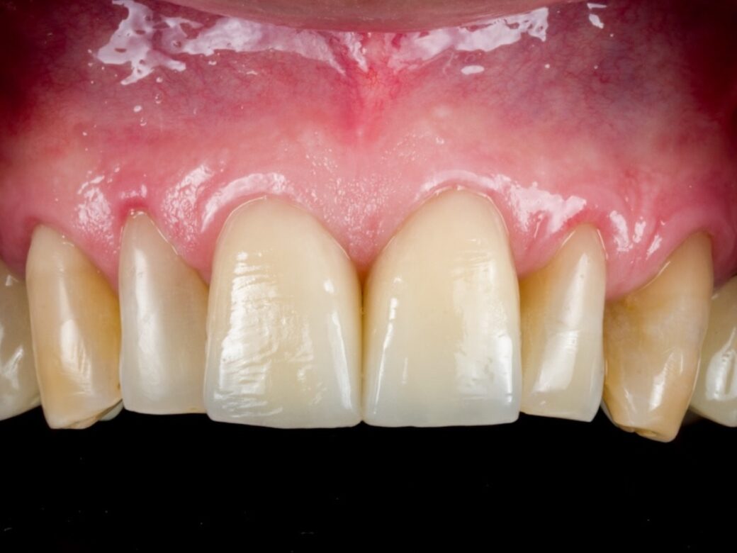 Estetica dentale — dopo