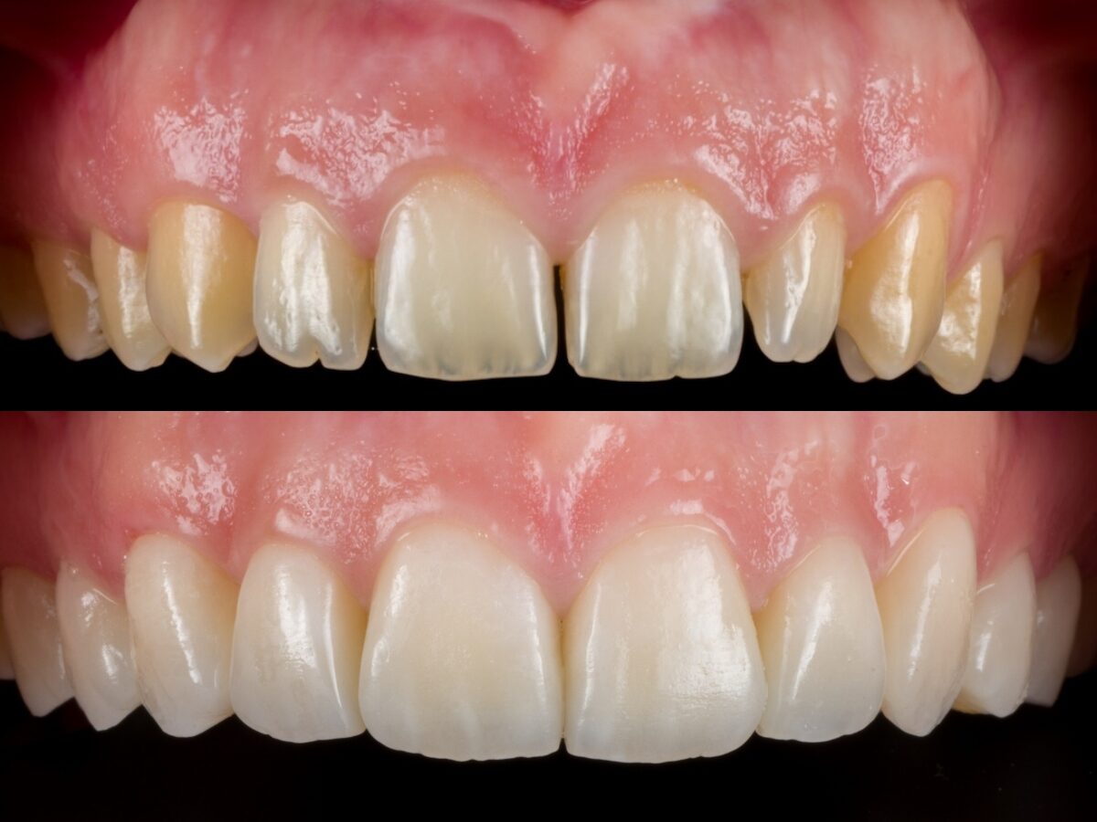 Faccette in ceramica — prima e dopo