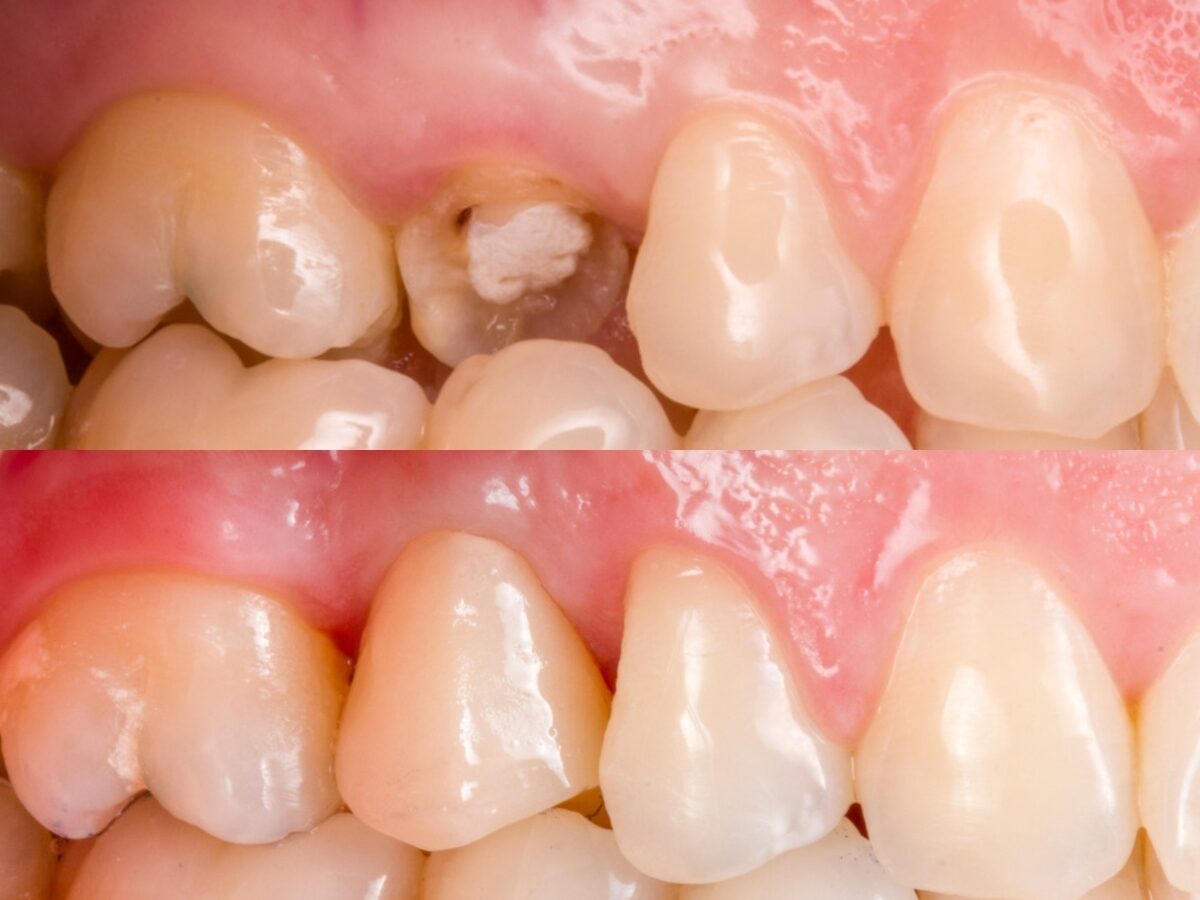 Corone estetiche — prima e dopo