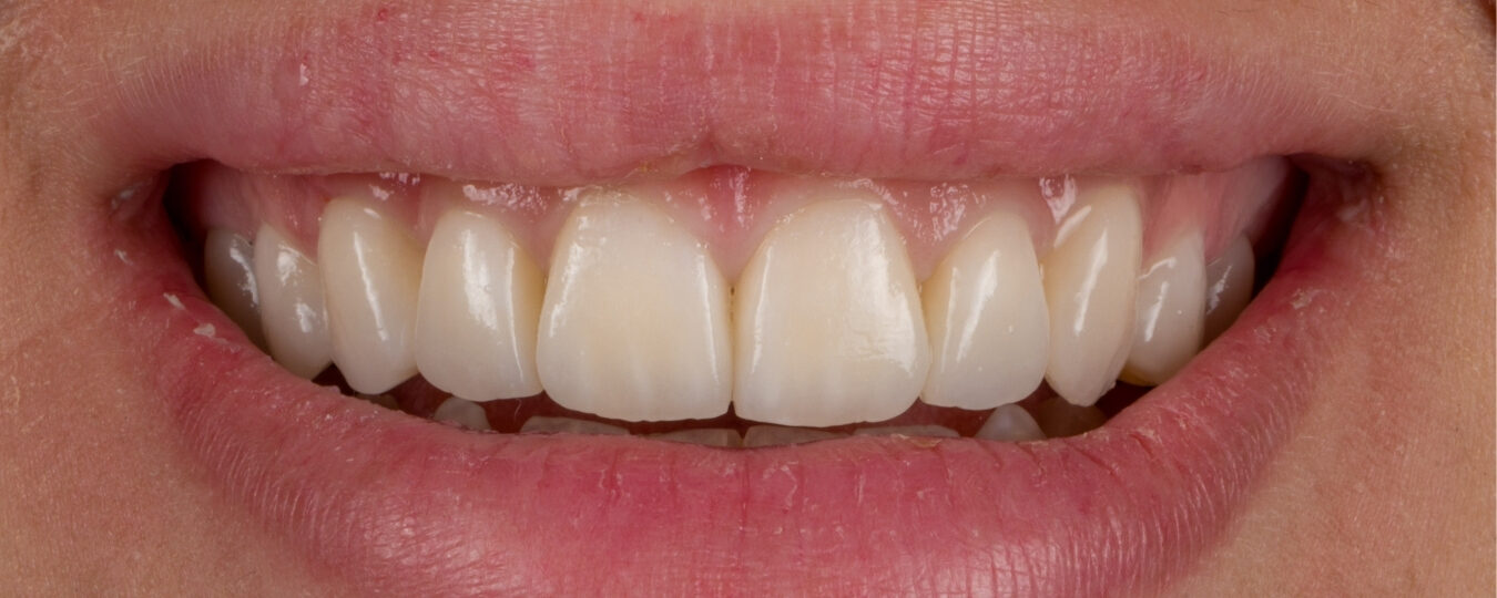 Faccette in ceramica — dopo il trattamento