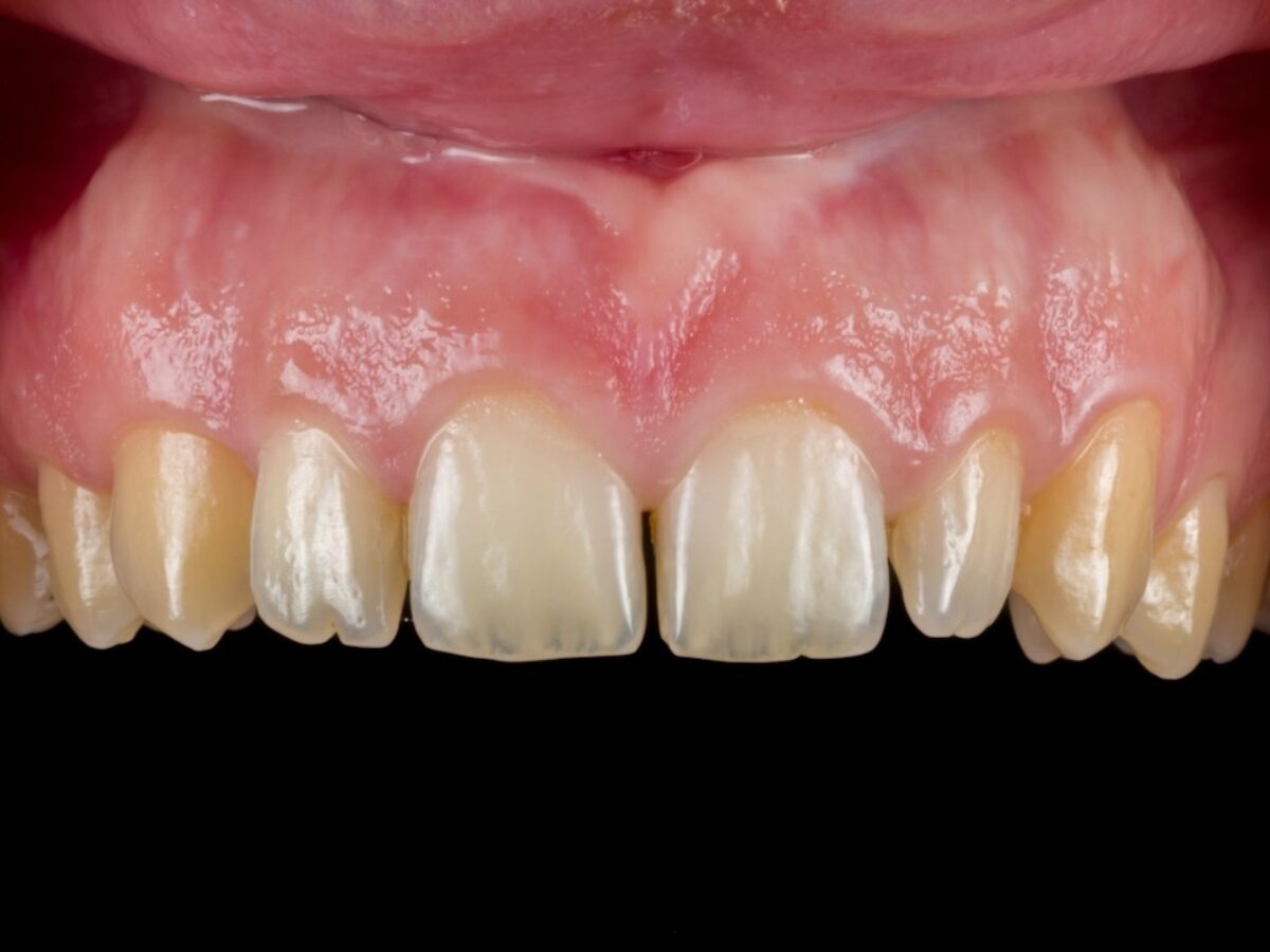 Faccette in ceramica fase 1 — prima visita e diagnosi