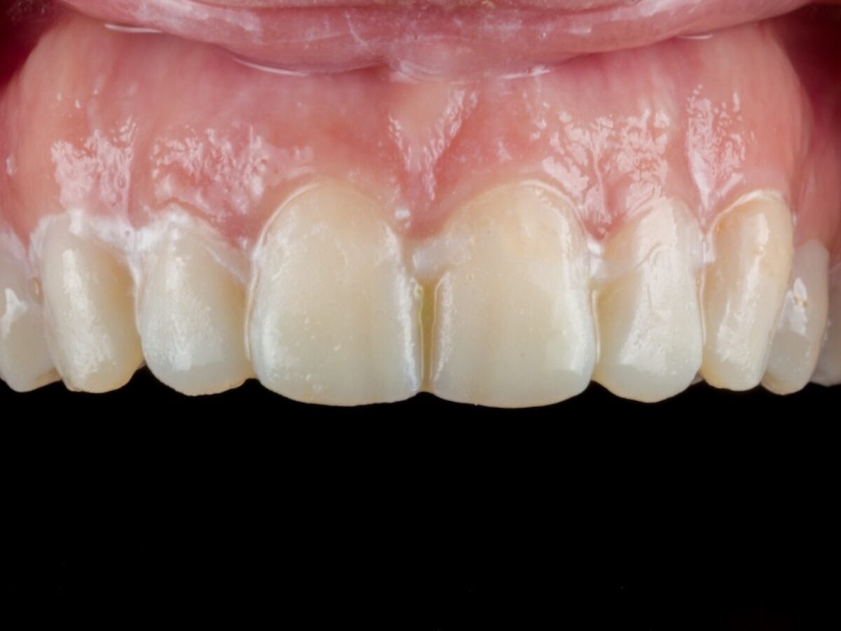Faccette in ceramica fase 2 — smile design e mock-up