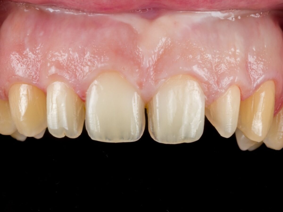 Faccette in ceramica fase 3 — preparazione e impronta