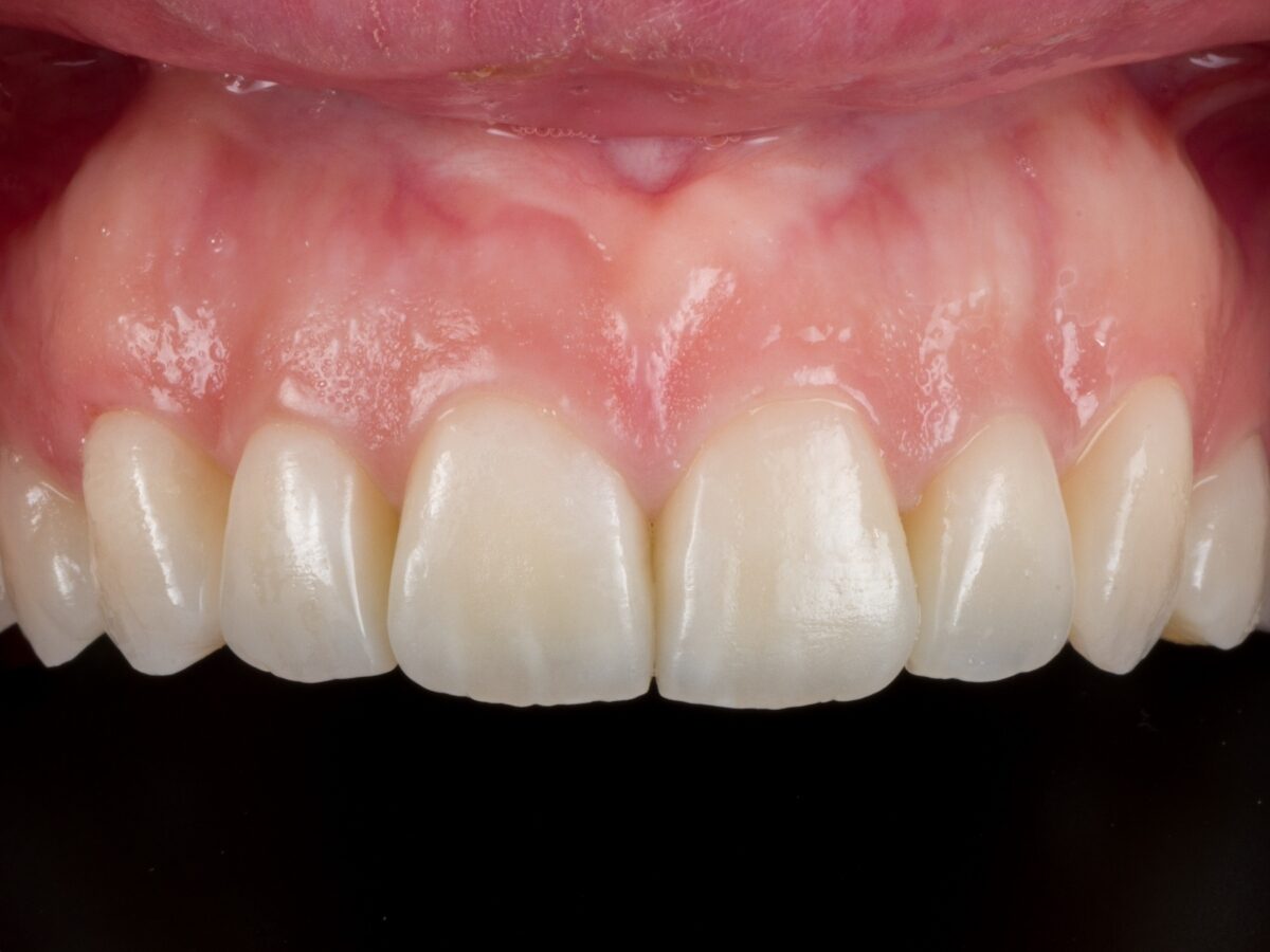 Faccette in ceramica fase 4 — applicazione definitiva