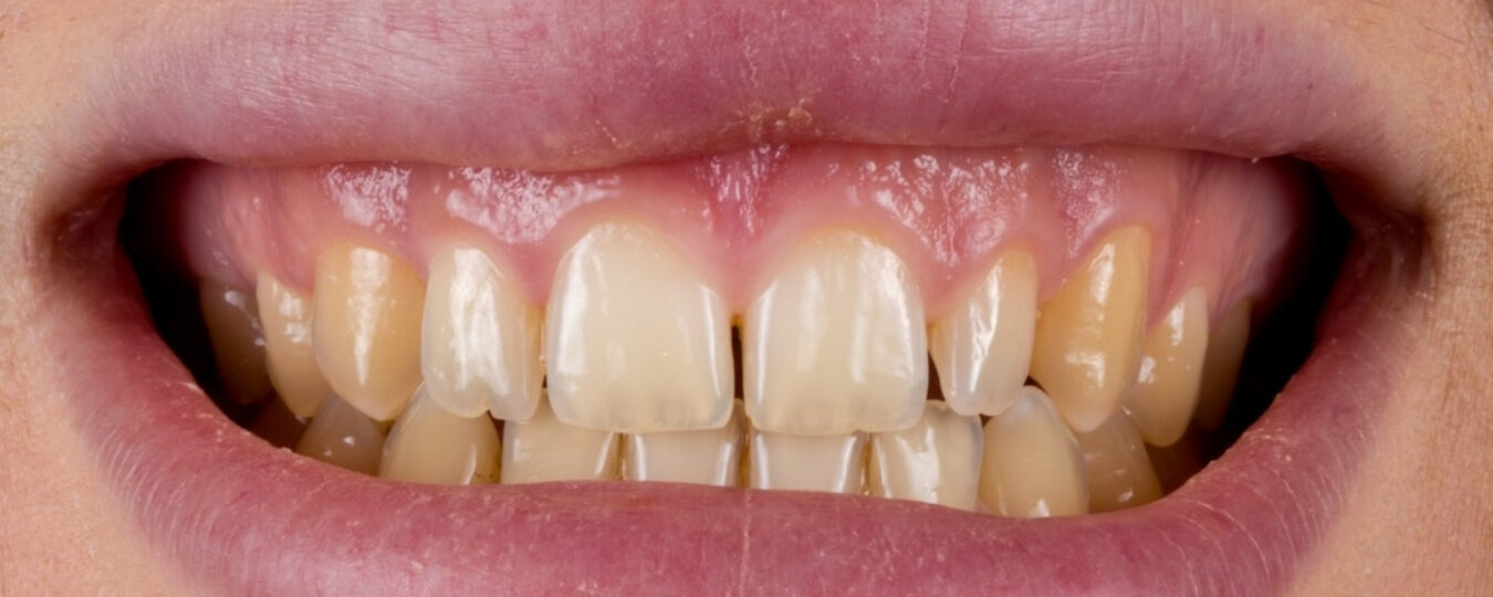 Faccette in ceramica — prima del trattamento