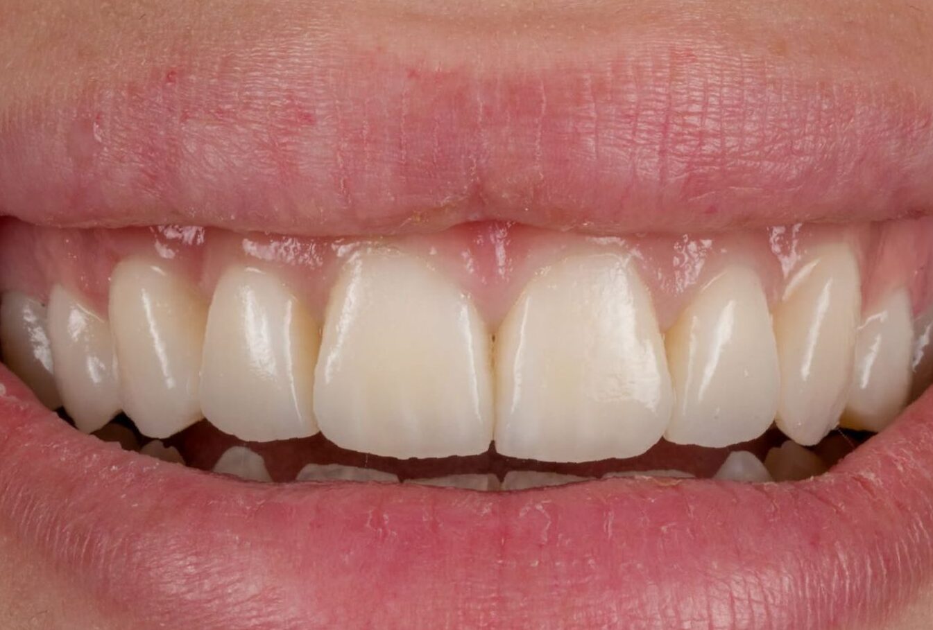 Estetica dentale — sorriso con faccette in ceramica, studio Odontoiatrica Mediterranea Torre Annunziata