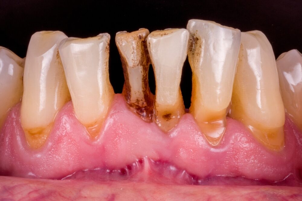 Corone su denti — caso 1