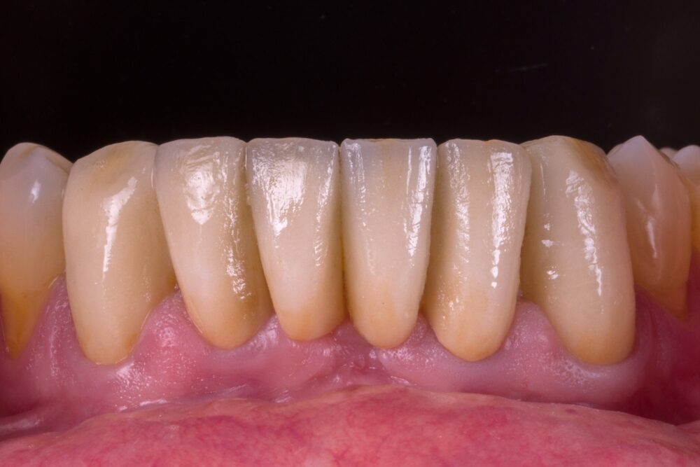 Corone su denti — caso 1
