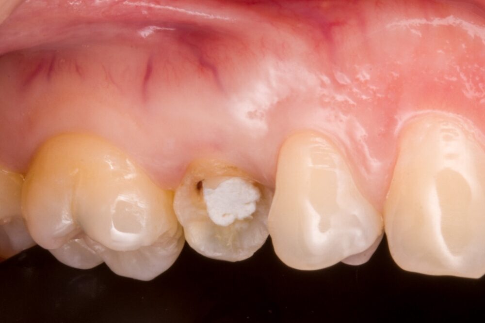 Corone su denti — caso 2