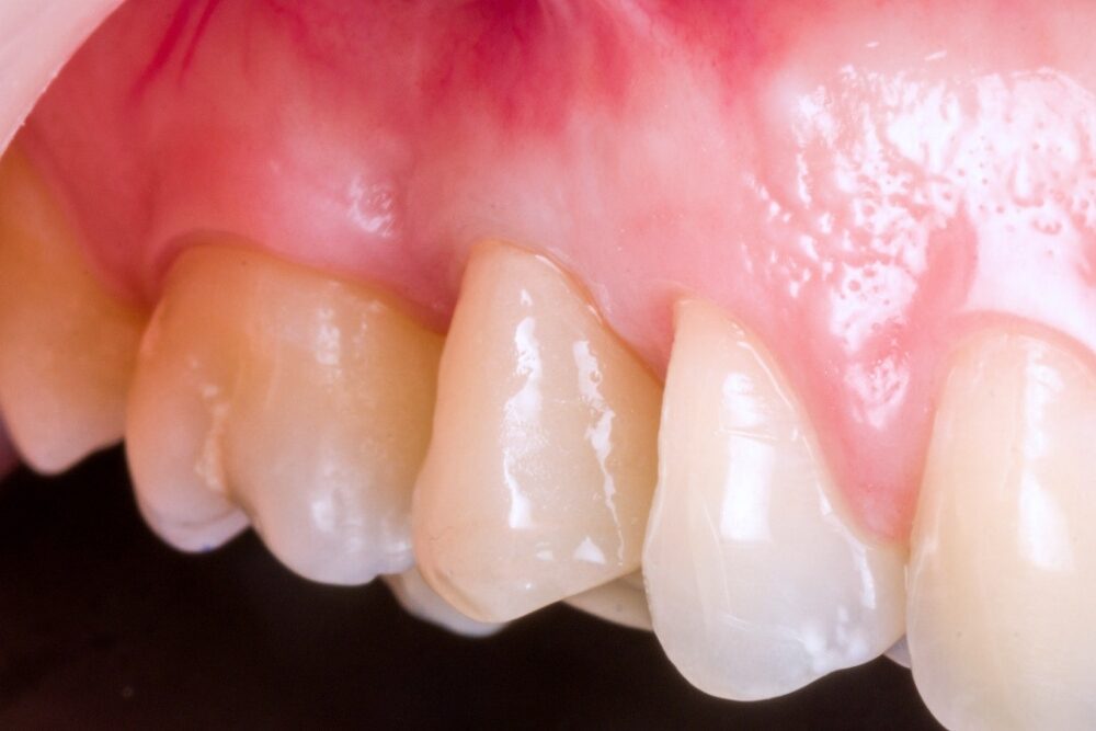 Corone su denti — caso 2
