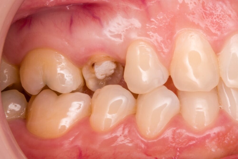 Corone su denti — caso 2