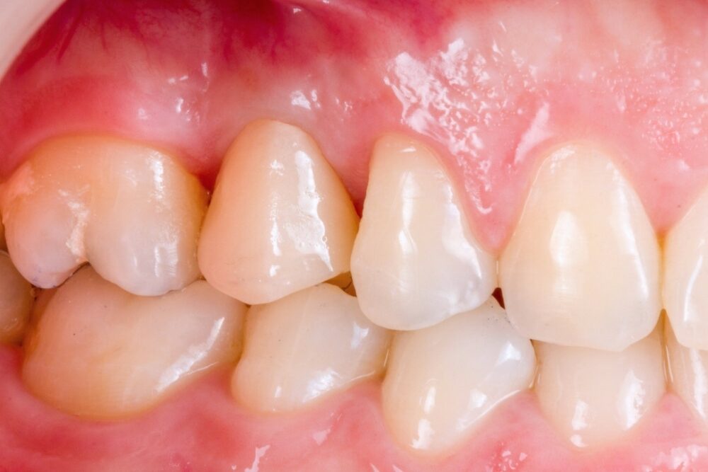 Corone su denti — caso 2