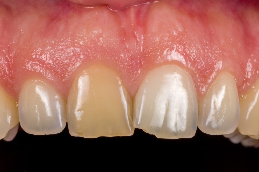 Corone su denti — caso 3