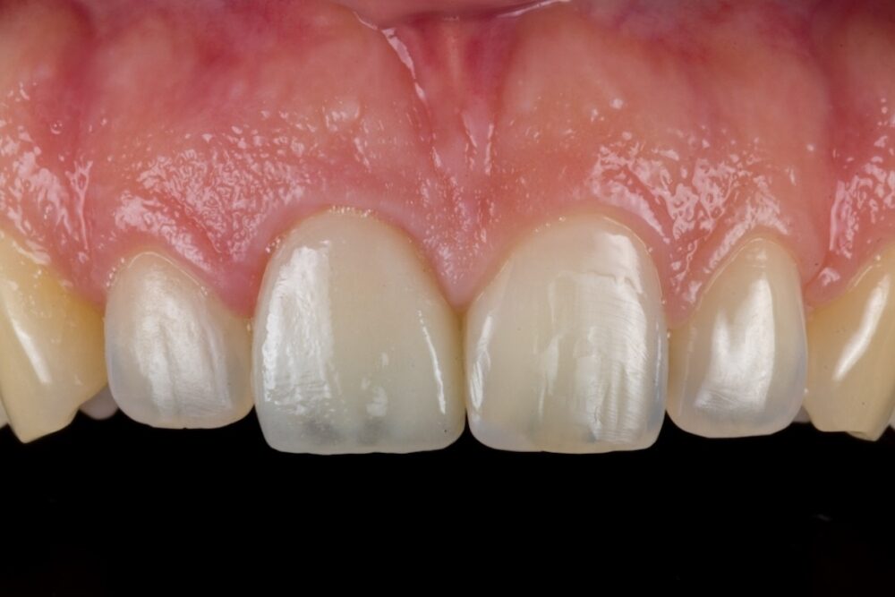 Corone su denti — caso 3