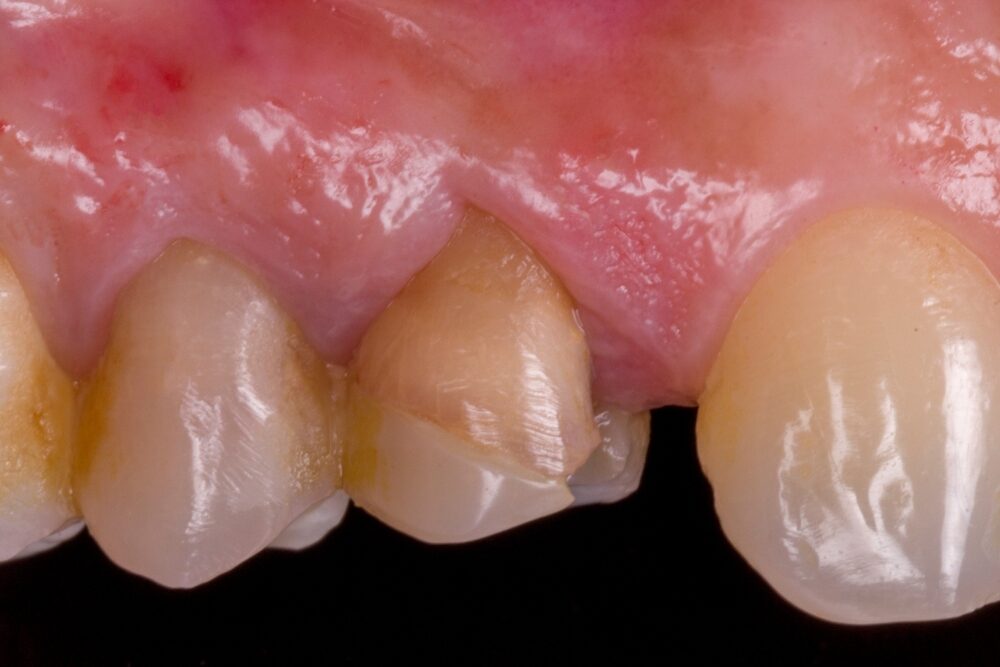 Corone su denti — caso 4