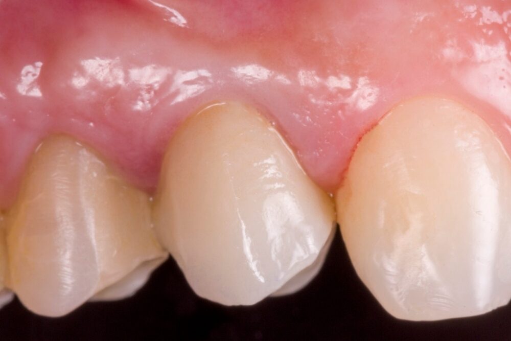 Corone su denti — caso 4