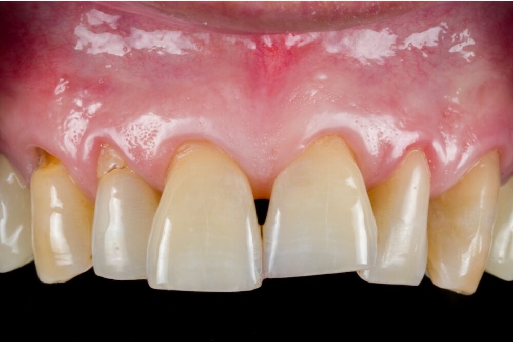 Corone su denti — caso 5