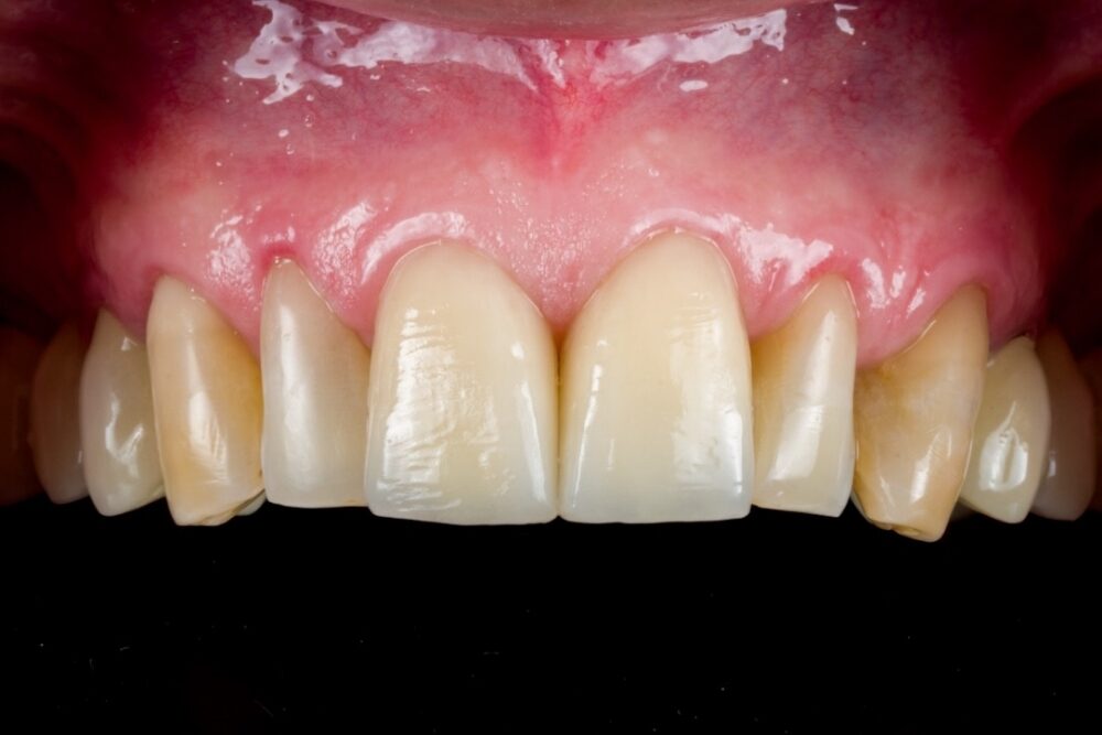 Corone su denti — caso 5