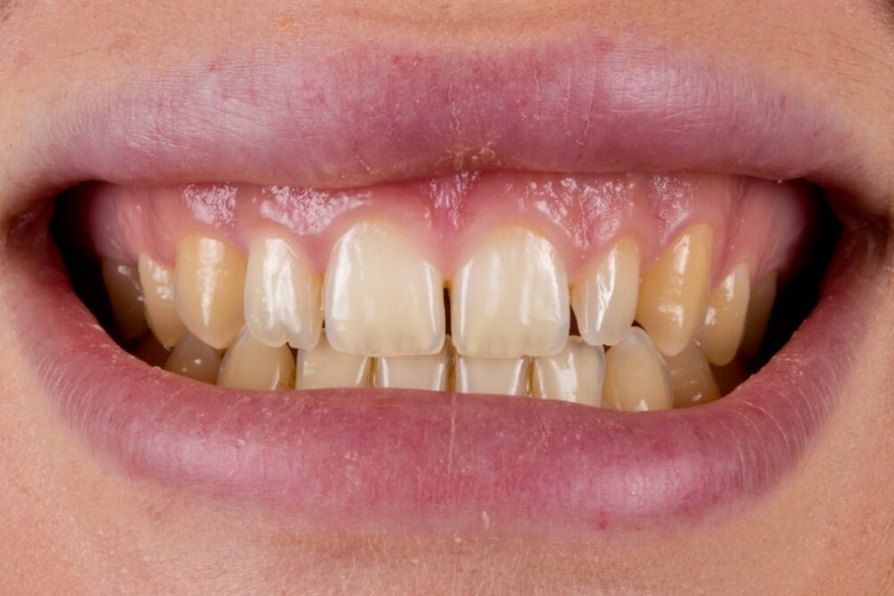 Faccette in ceramica — caso 1