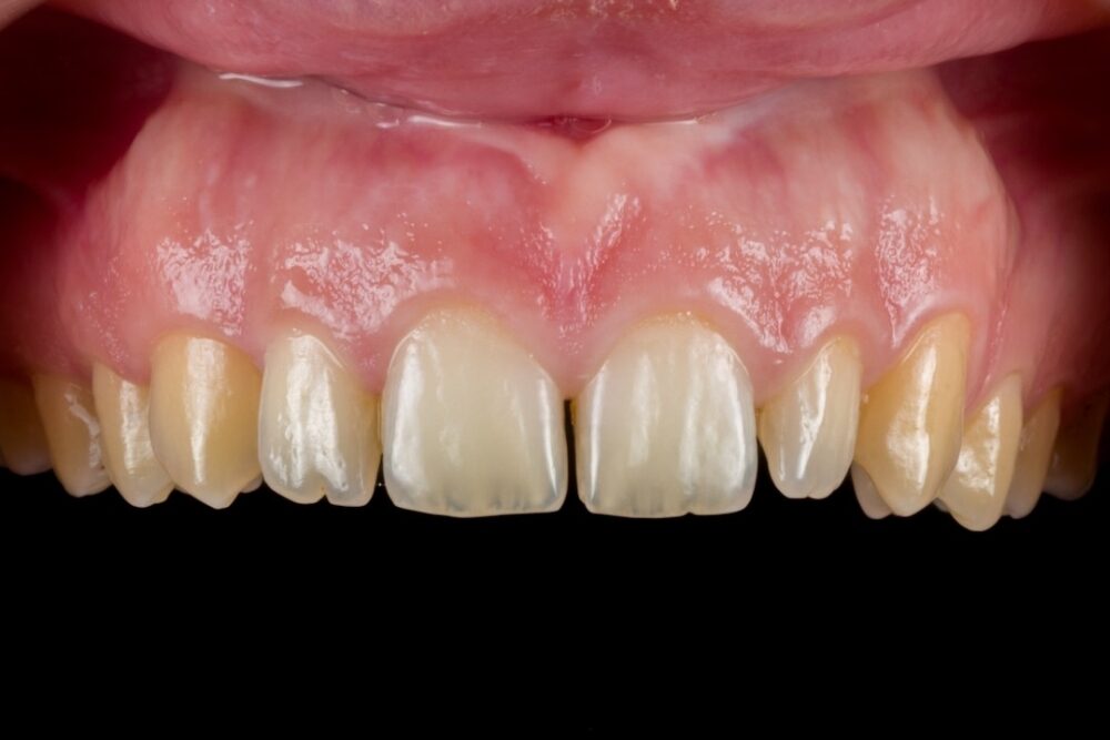 Faccette in ceramica — caso 1