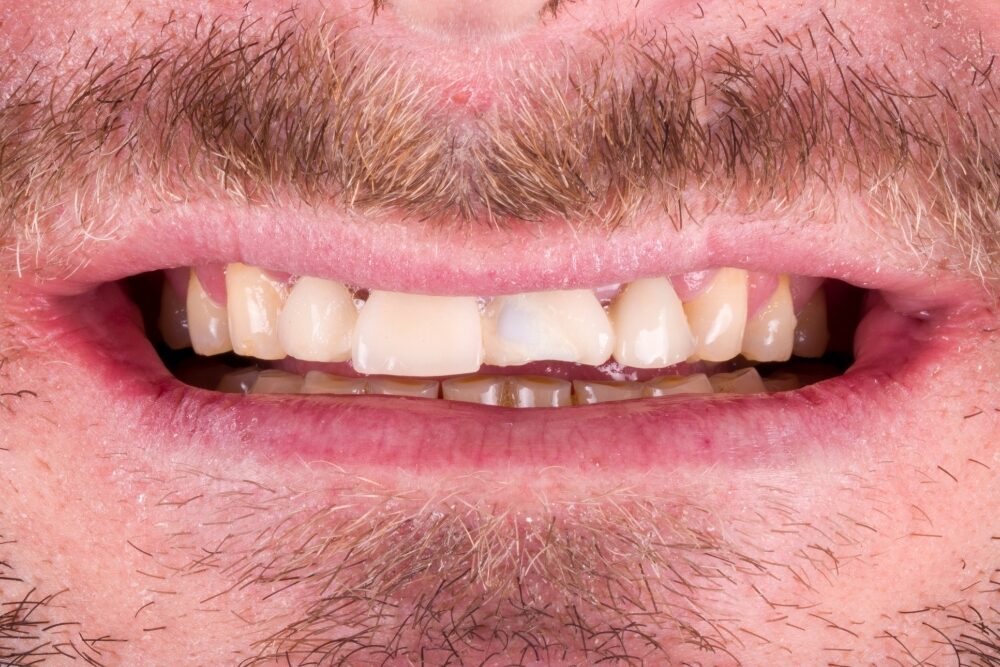 Riabilitazione completa — caso 2