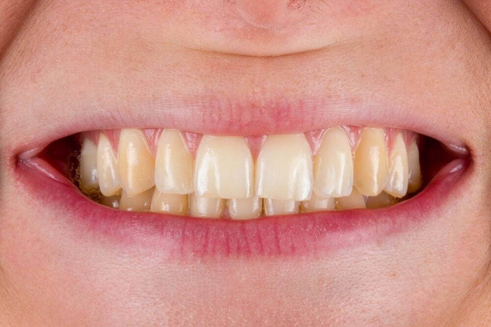 Sbiancamento professionale — caso 3