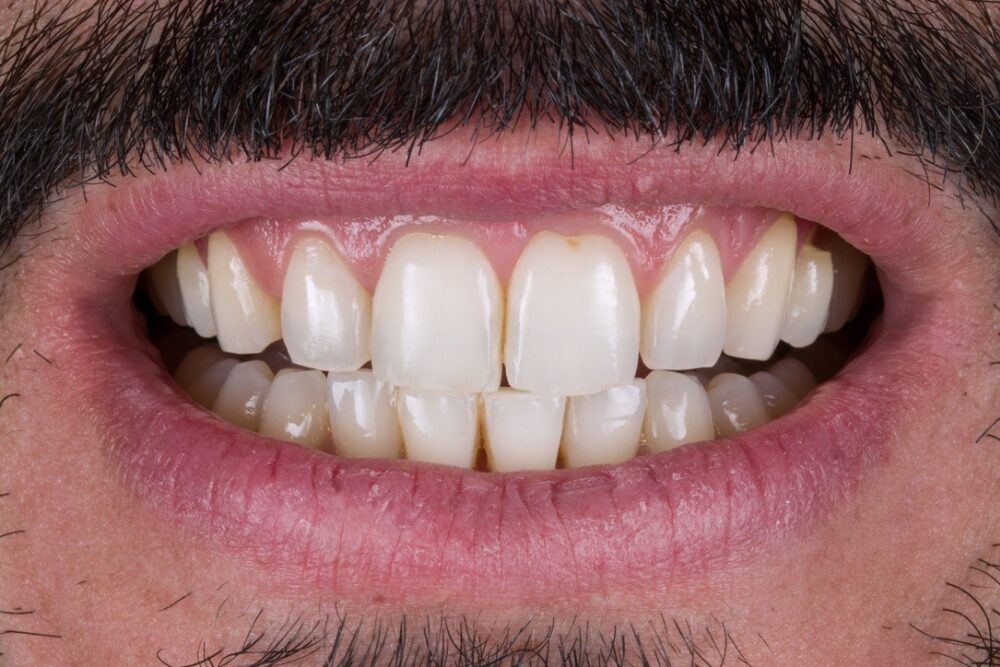 Sbiancamento professionale — caso 5
