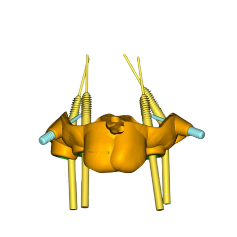 Rendering 3D di pianificazione implantare su mascella
