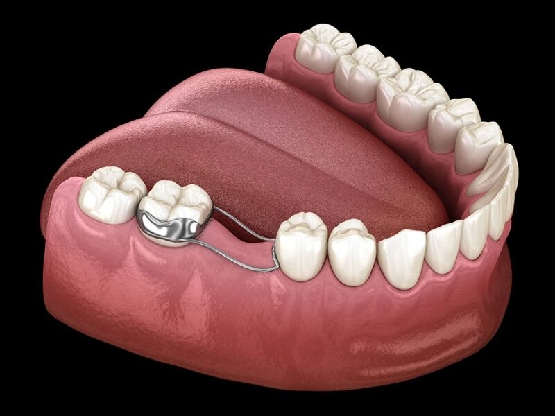 Mantenitore di spazio per denti da latte