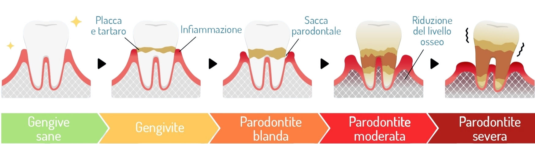 Progressione dalla gengivite alla parodontite severa