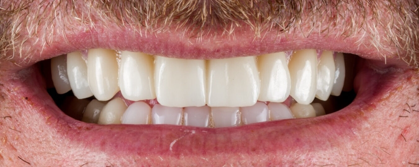 Riabilitazione completa — dopo il trattamento