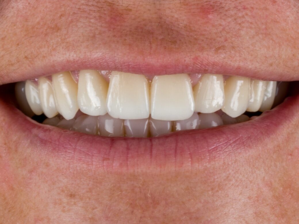 Estetica dentale — dopo
