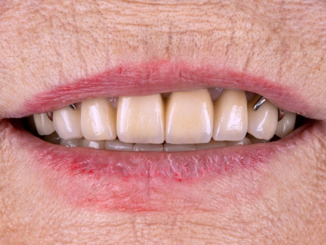 Estetica dentale — dopo
