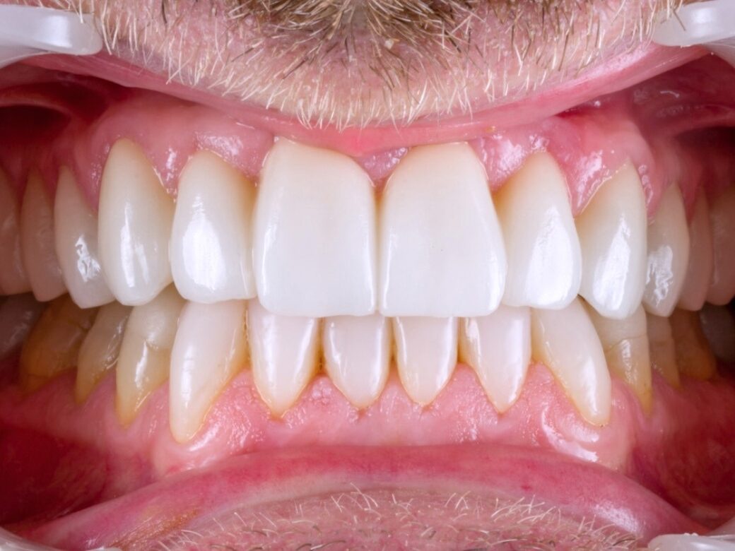 Estetica dentale — dopo