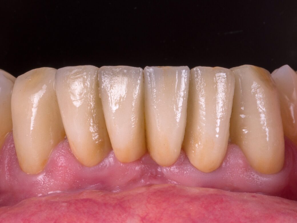 Estetica dentale — dopo