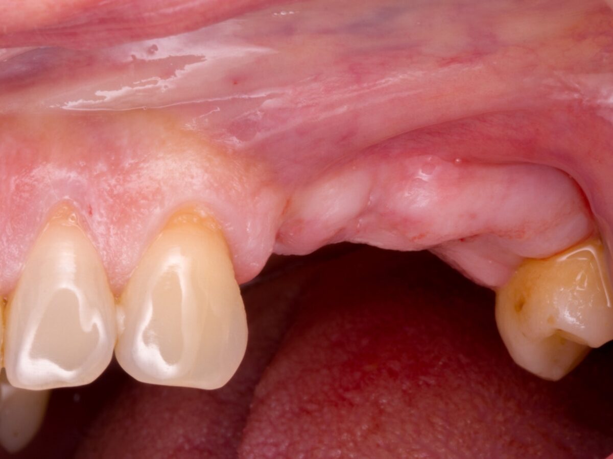 Rigenerazione ossea fase 1 — prima visita e diagnosi