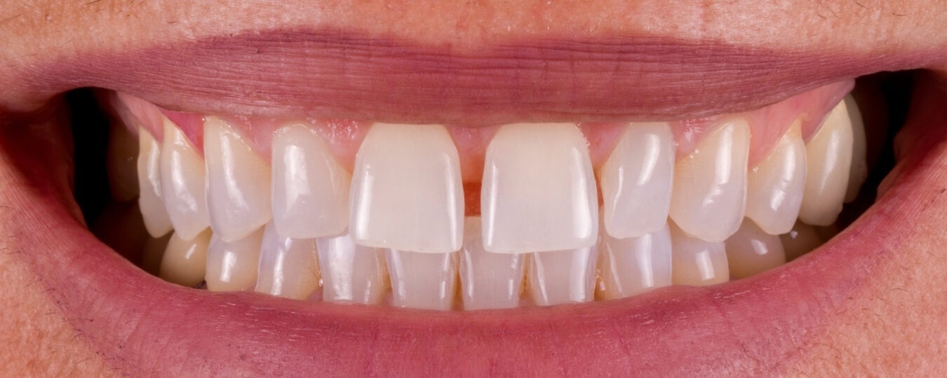 Sbiancamento dentale — dopo il trattamento