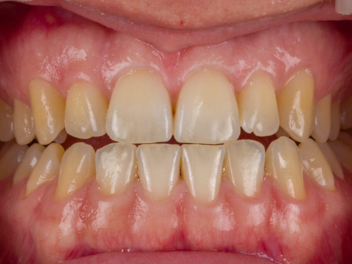 Sbiancamento dentale fase 1 — visita e valutazione del colore