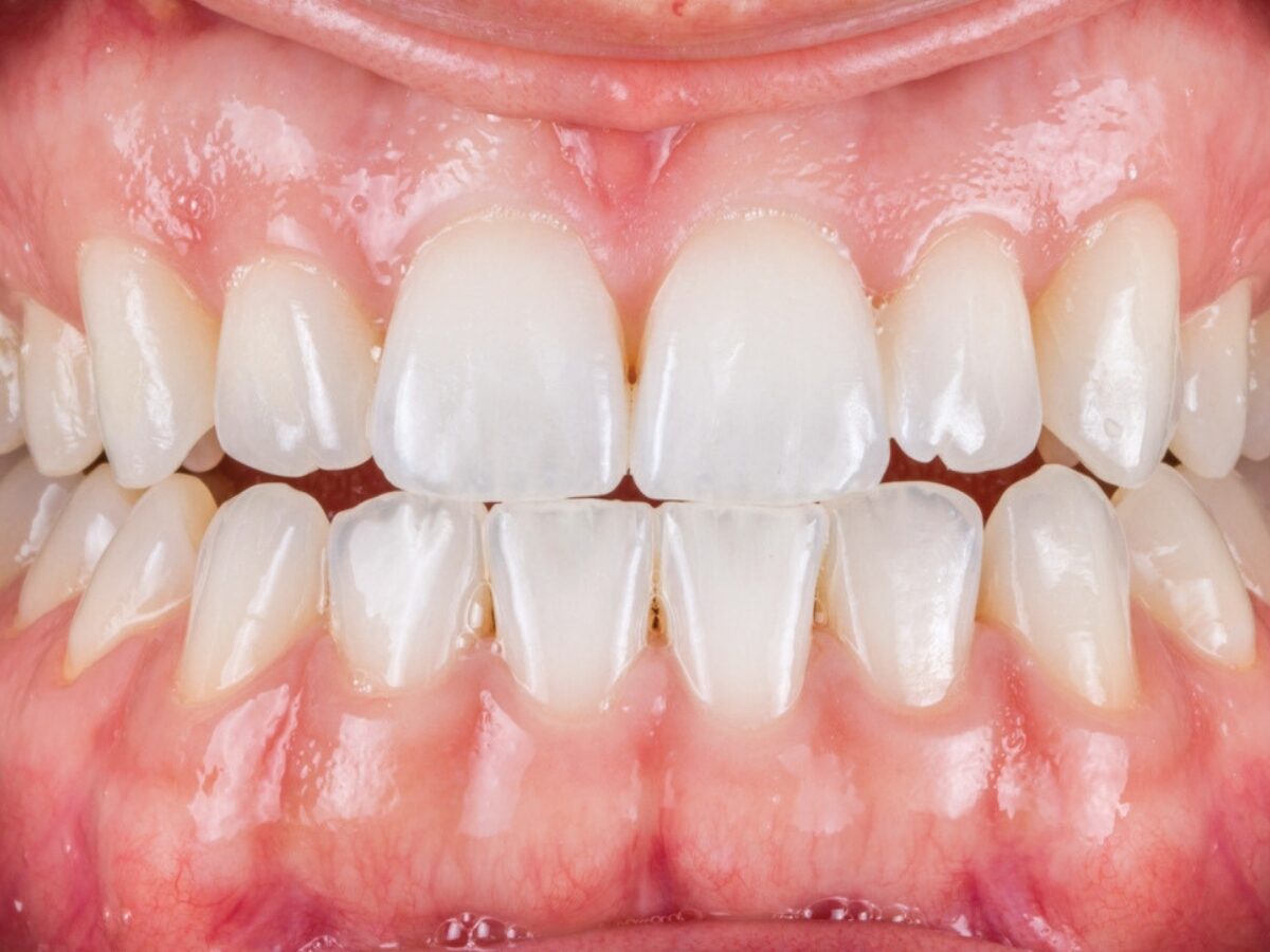Sbiancamento dentale fase 3 — controllo e risultato