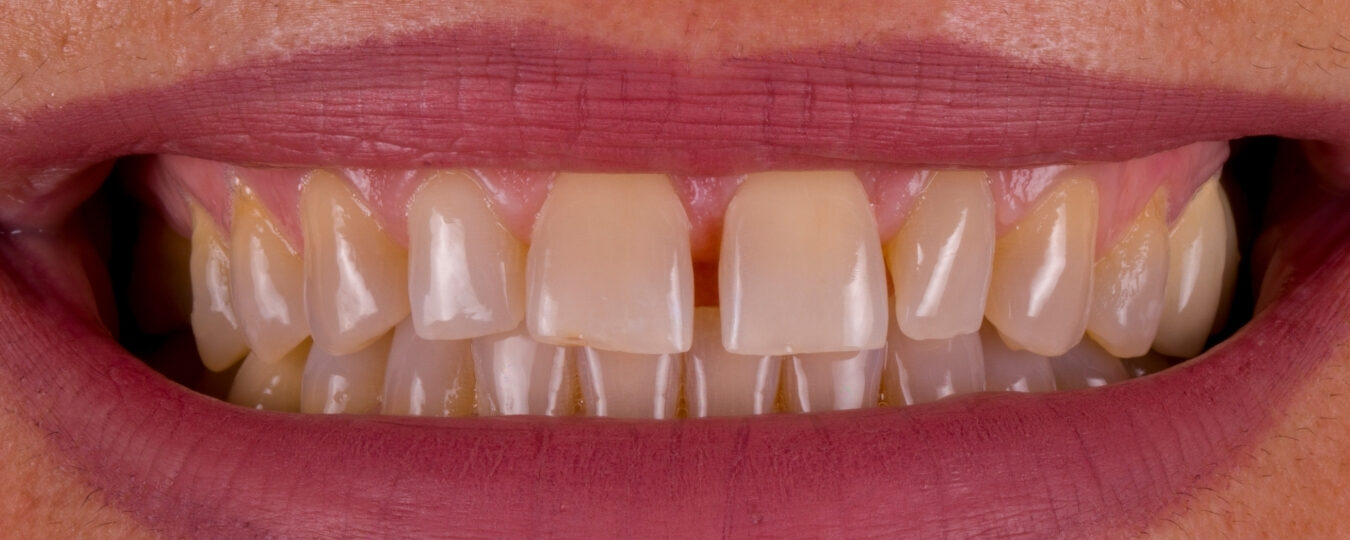 Sbiancamento dentale — prima del trattamento
